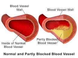process for heart disease, blocked artery
